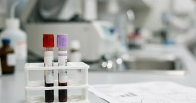 Provetta per l'esame del sangue che confronta PCR e VES, i due indici di infiammazione, in laboratorio di analisi
